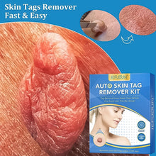Skin Tag Remover Kit 2 in 1 for Micro to Large (2 mm - 8 mm / 1 Set) - justgrabit.in | Just Grab It