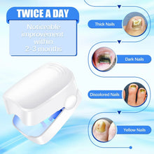 Rechargeable Nail Fungus Laser – Anti - Fungal Device for Toenails, Hands & Feet (Home Use) - Justgrabit Inc.