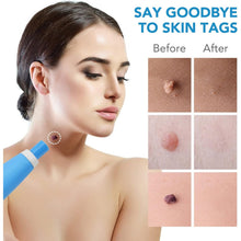Skin Tag Remover Kit 2 in 1 for Micro to Large (2 mm - 8 mm / 1 Set) - justgrabit.in | Just Grab It